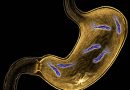 Helicobacter pylori: la infección silenciosa que puede aumentar el riesgo de cáncer gástrico